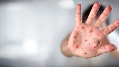 На Прикарпатті зафіксовано спалах кору