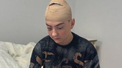 У Львові лікарі видалили 17-річному підлітку рідкісну пухлину в мозку