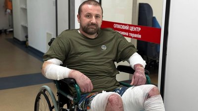 У Львові за допомогою шкіри свині та риби врятували чоловіка після вибуху бойлера (ФОТО)