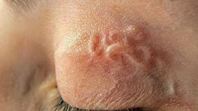 У Львові з ока жінки лікарі дістали 7-сантиметрового паразита