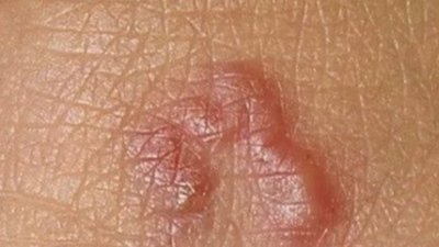 У Львові хірурги дістали з-під шкіри жінки 12-сантиметрового паразита