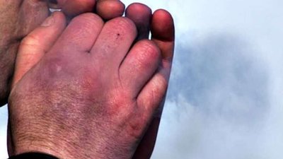 На Львівщині чоловік потрапив у реанімацію через переохолодження