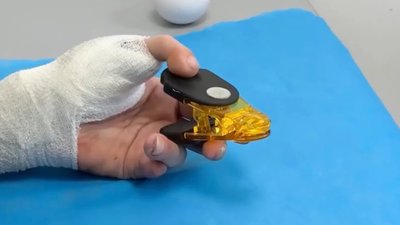 У Superhumans пораненому воїну лікарі пересадили палець із ноги на руку