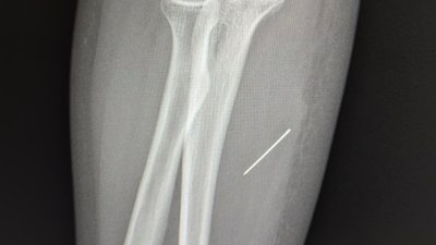 На Львівщині школярка тиждень ходила з голкою у руці